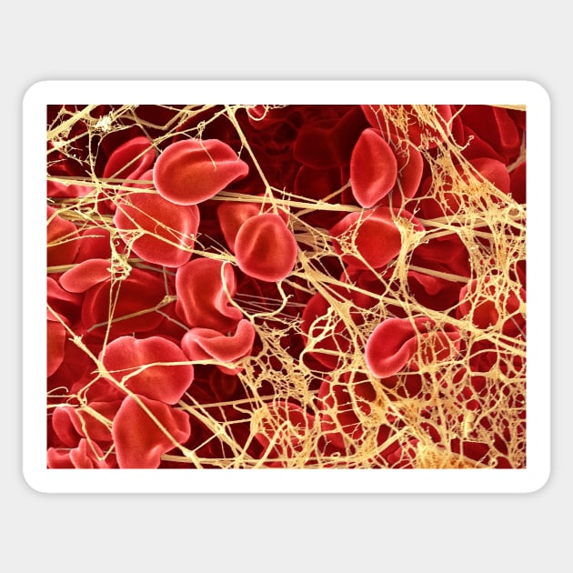 Blood clot, SEM (P260/0107) Sticker by SciencePhoto